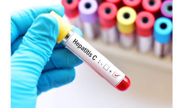 Hepatitidu C už lékaři umějí snadno vyléčit. Jen se na ni musí přijít  